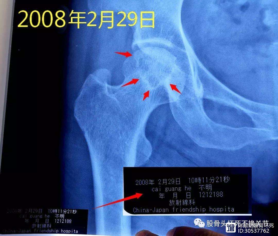 鄂州人工骨头医保报销多少(人工骨头医保报销多少比例)