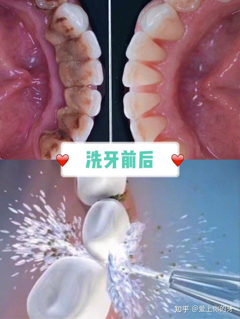 鄂州洗牙可以用医保吗(洗牙可以用医保吗,报销比例多少)